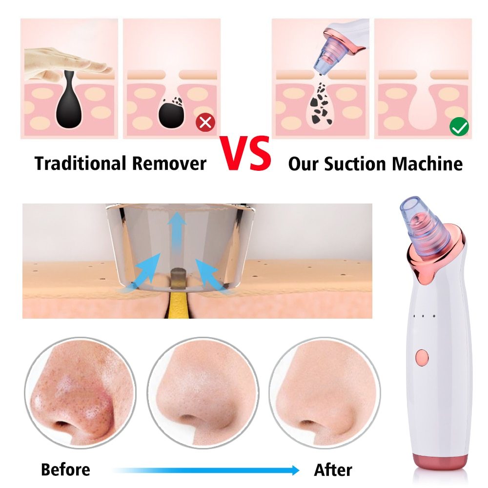 Blackhead Instrument Electric Suction